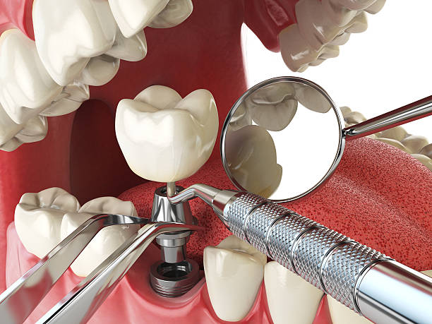 Best Dental Abscess Treatment in Searingtown, NY